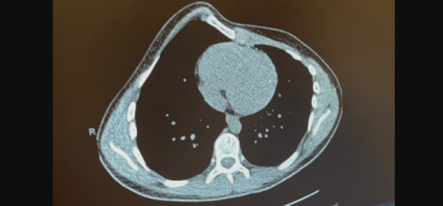 x-ray of teen with chest wall deformity
