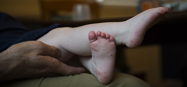 Child's feet with hand, foot and mouth disease