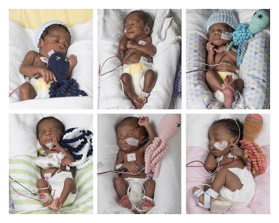 Sextuplets successfully delivered at VCU Medical Center