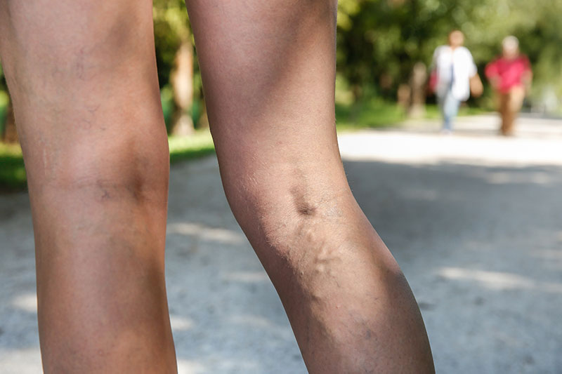Vericose veins image